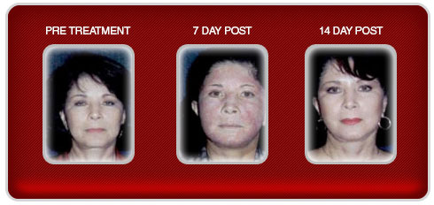 laser-resurfacing-trial